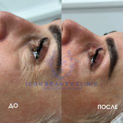 Фотона глаза 6